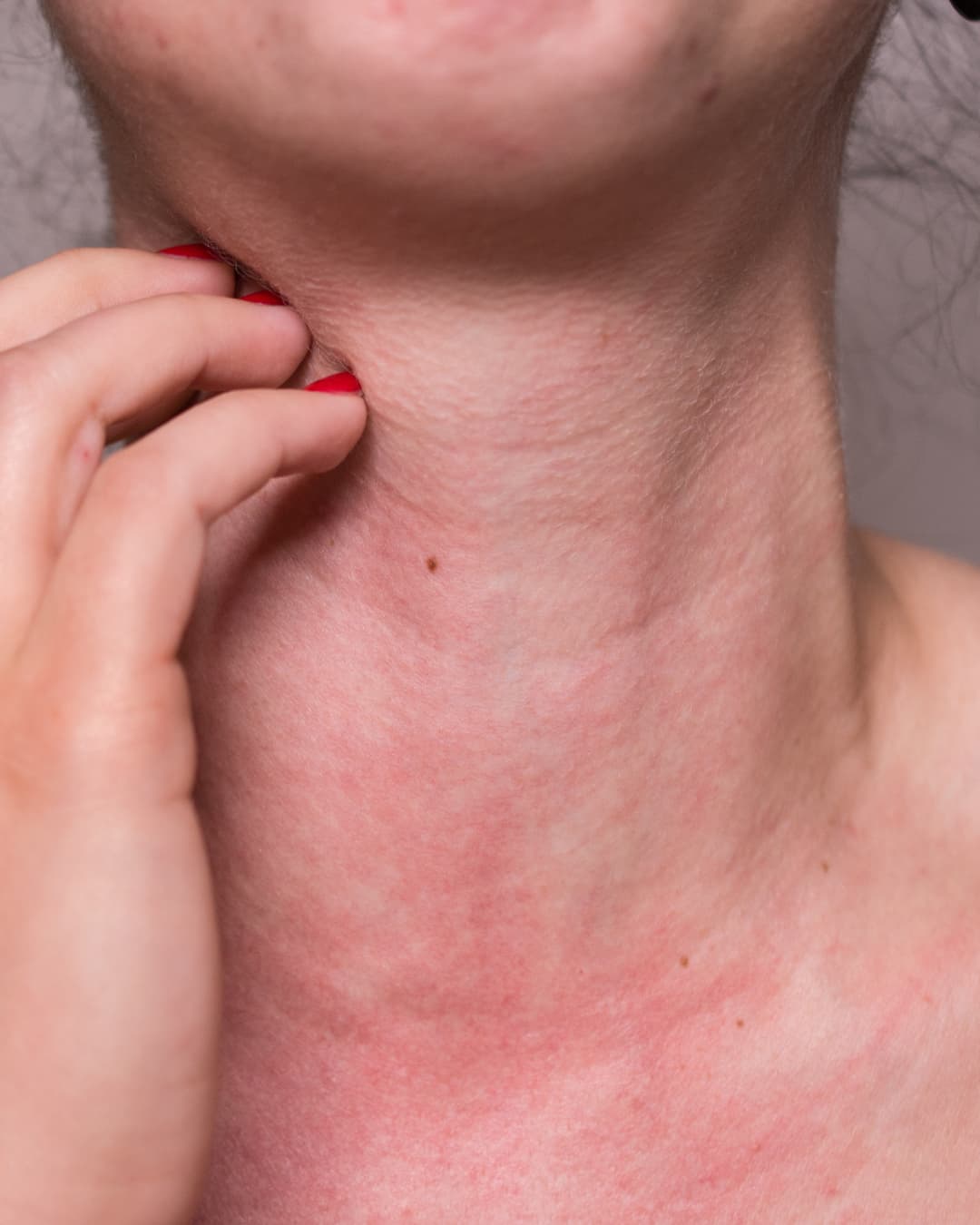 Alergia a Medicamentos