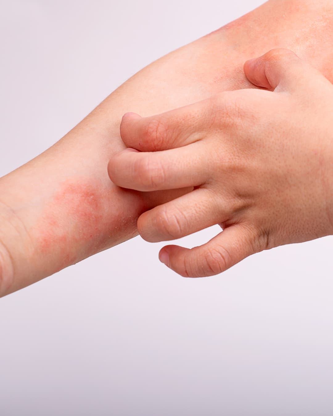 Dermatitis