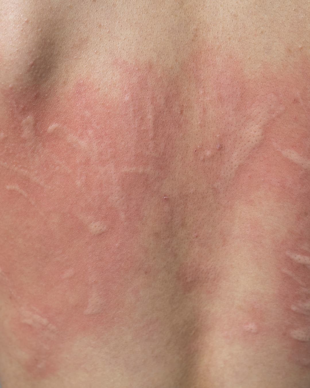 Urticaria Crónica